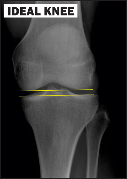 Chiropractic La Porte IN Ideal Knee Chiropractic La Porte IN Ideal Knee