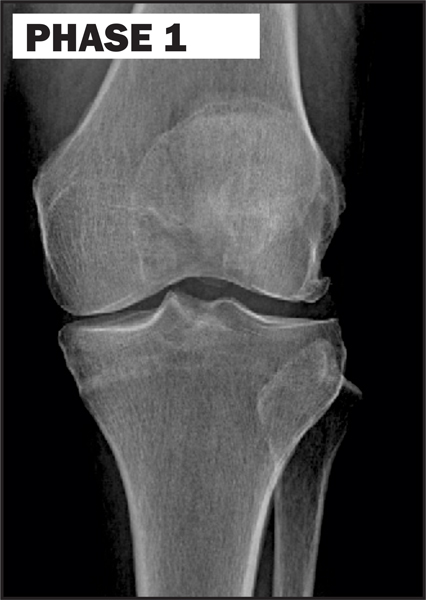 Chiropractic La Porte IN Knee Degeneration Phase 1 Chiropractic La Porte IN Knee Degeneration Phase 1