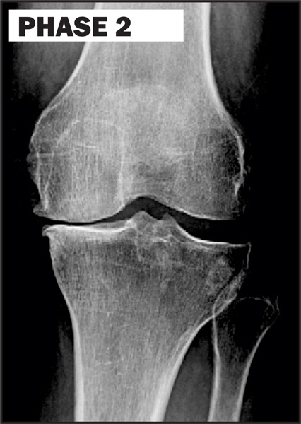 Chiropractic La Porte IN Knee Degeneration Phase 2 Chiropractic La Porte IN Knee Degeneration Phase 2