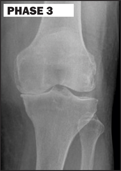 Chiropractic La Porte IN Knee Degeneration Phase 3 Chiropractic La Porte IN Knee Degeneration Phase 3