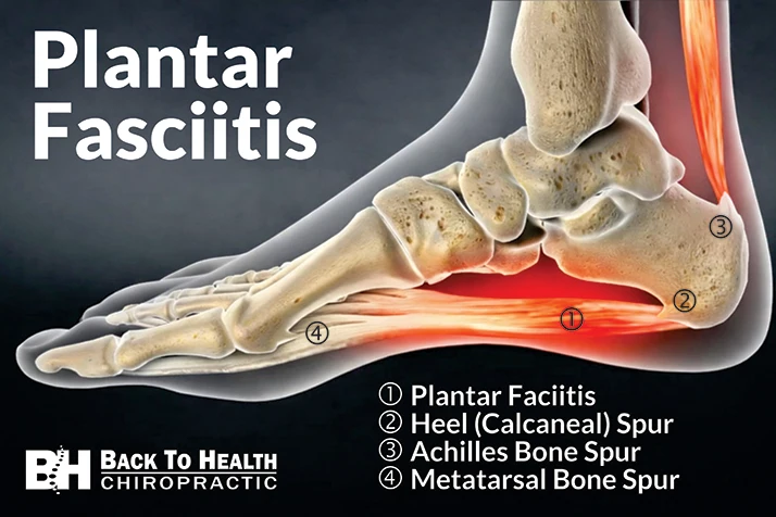 Plantar Fasciitis Foot X-Ray View of Bones
